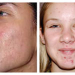 SilkPeel-before-and-after
