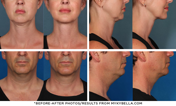 Before and after photos - Results from Kybella