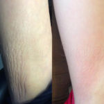 Before and after results of using SkinPen on arm stretchmarks
