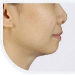 Non-surgical chin augmentation and jaw shaping