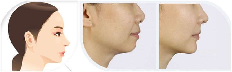 Non-surgical chin augmentation and jawline shaping