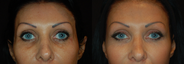 Before and after treatment of under eye bags