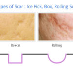 Types of scars: Ice Pick, Box, Rolling Scar