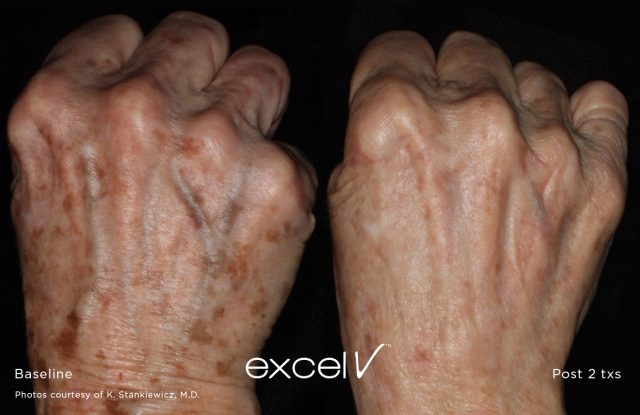 Hands before and after 2 excel V treatments