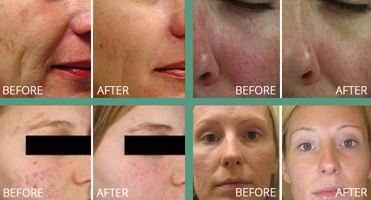 Set of 4 before and after photos featuring laser genesis treatment