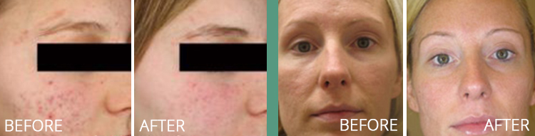 Set of 2 photos showing before and after laser genesis acne treatment