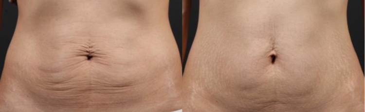 Stomach before and after truSculpt 3D treatment