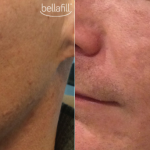 Bellafill for acne scars