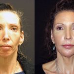 Life-changing results with fillers