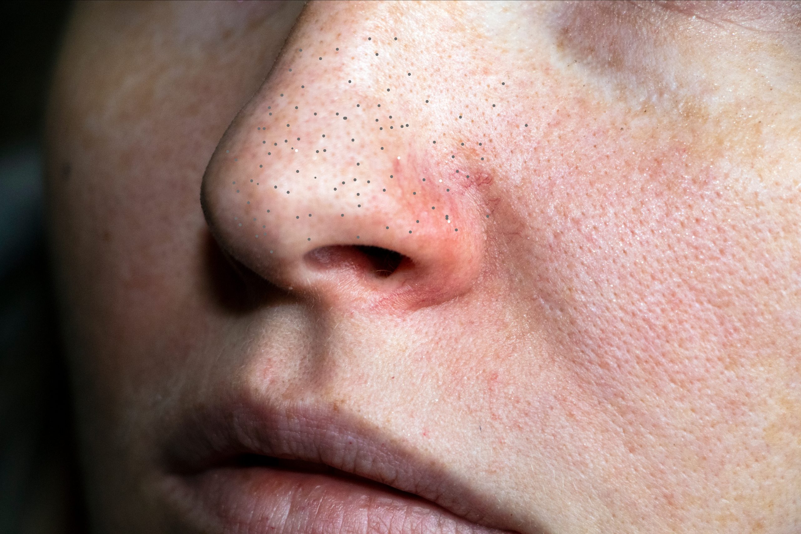 Sebaceous Filaments - Skin by Design Dermatology & Laser Center, PA