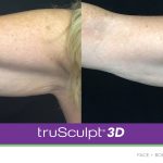 truSculpt-3D-B-A-Image-18