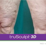 truSculpt-3D-B-A-legs-1